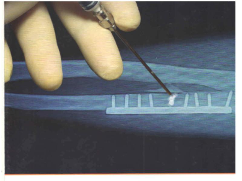 risk odf ectopic bone