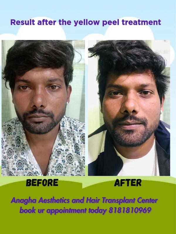 patient got affective ressult of yellow 