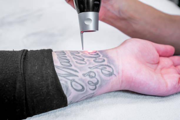 laser treatment techniques