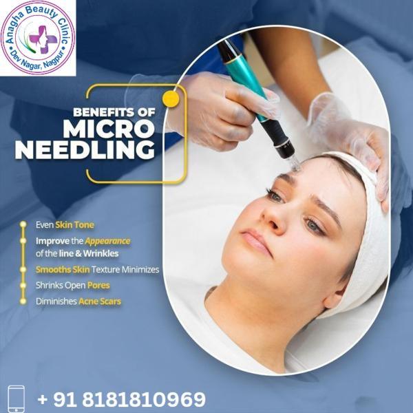 •Microneedling can help improve the appe