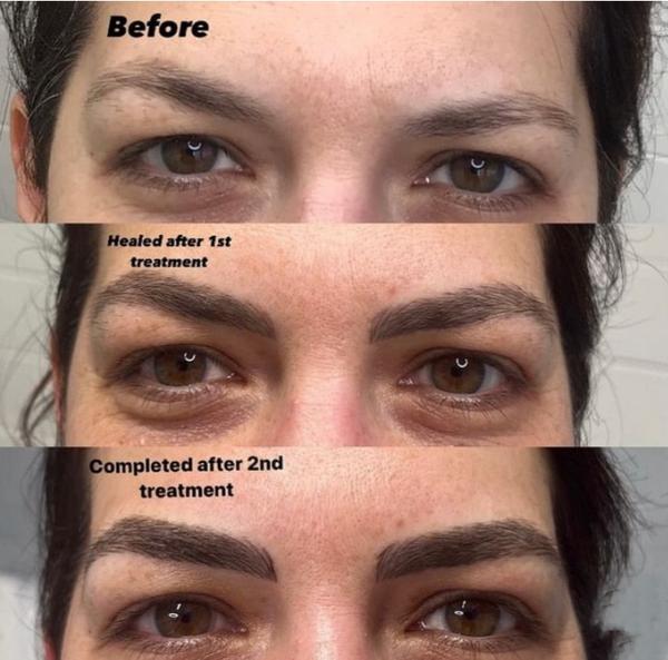 Microblading is a tattooing technique wh