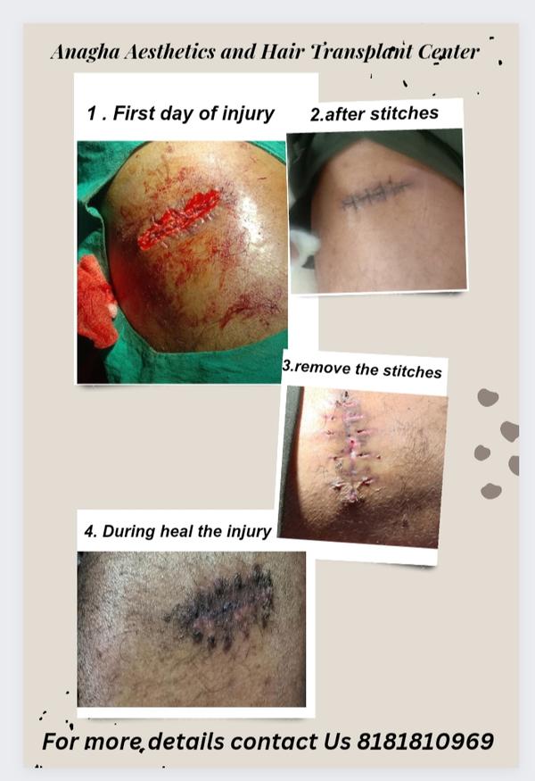 best treatment for scar and injury treat