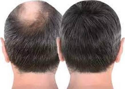 Transform Your Look with Non-Invasive Ha