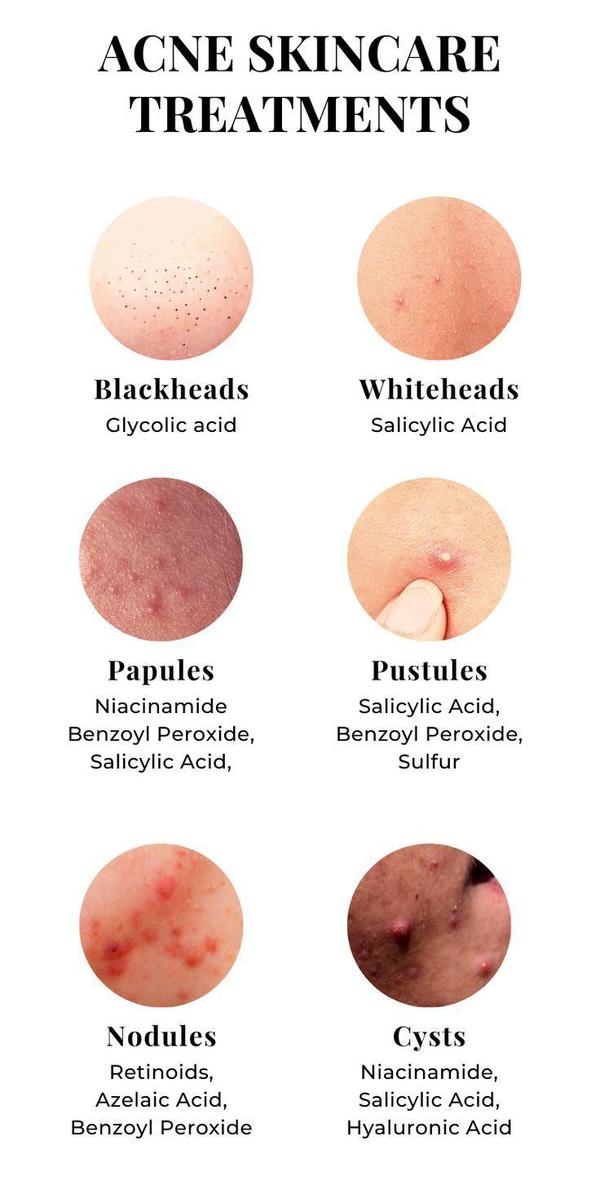 popping acne