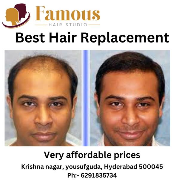 Best hair patch for baldness i