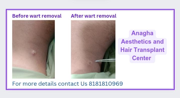 warts removal by CO2 best for skin treat