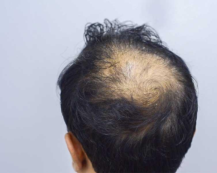 Crown Area Hair Patch
Crown Area Hair Pa