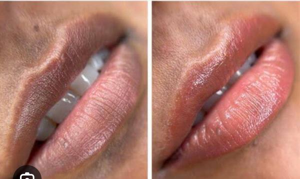 Laser lip lightening is an excellent non