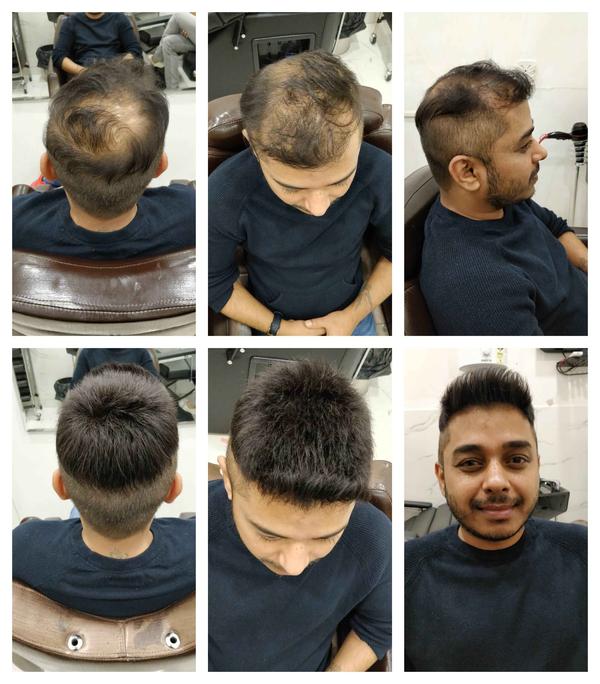 Hair Replacement in Bhandup west Mumbai