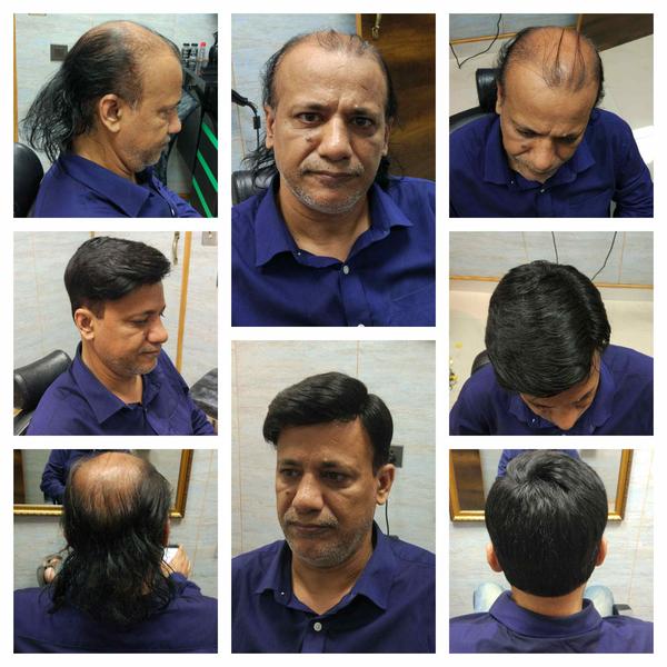 Hair Replacement in Kharghar Mumbai-
Hai