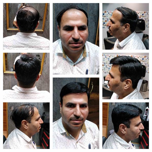 Hair Replacement in Navde Mumbai-
Hair l