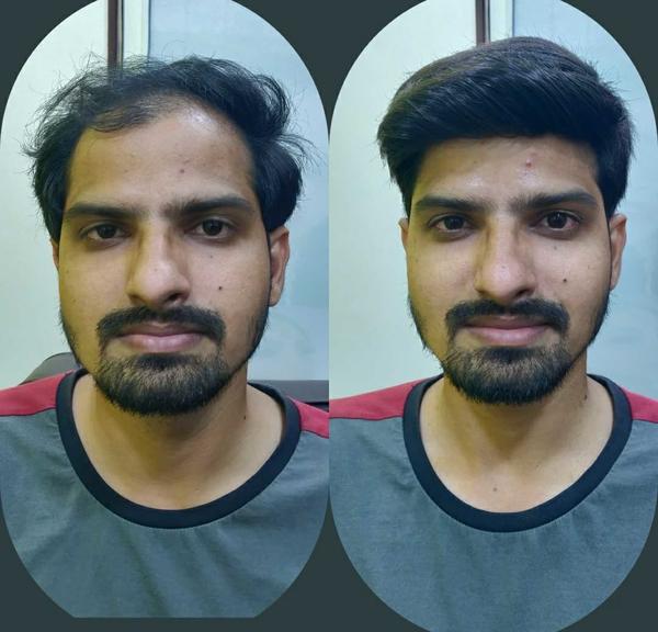 hyderabad micro ring hair exte