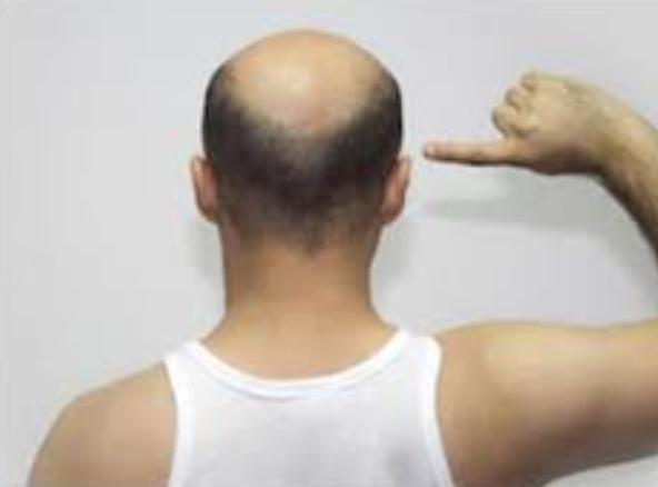 Non-Surgical Hair Replacement in Chennai