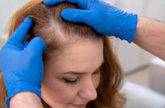 Non-Surgical Hair Solutions in Chennai E