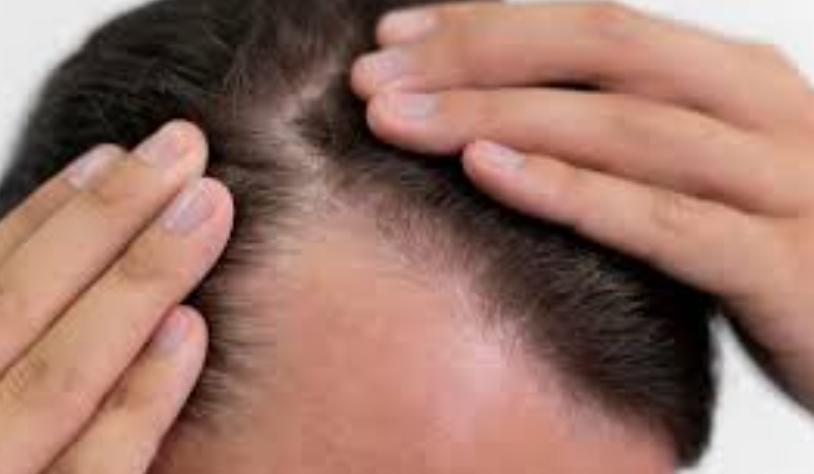 Non-Surgical Hair Transplant Cost in Che