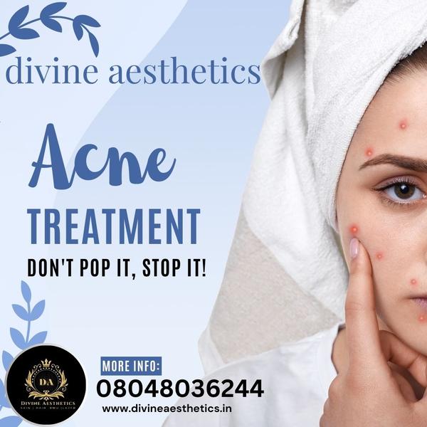 acne treatments