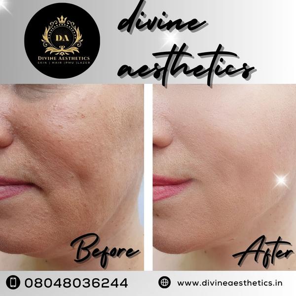basic hydrafacial