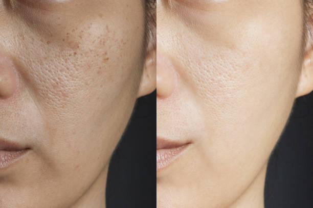 basic hydrafacial
