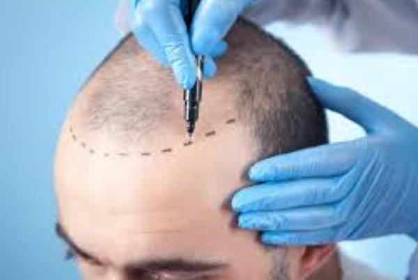 Non-Invasive Hair Transplant in Chennai