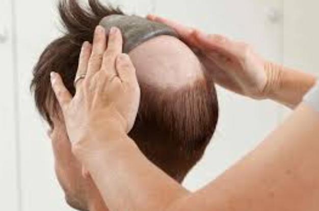 Non-Surgical Hair Replacement Cost in Ch