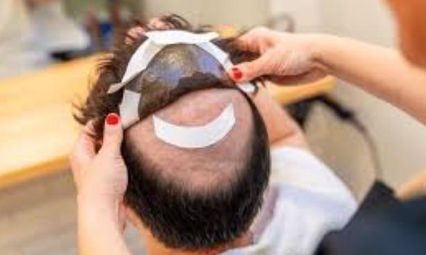 Permanent Hair Wigs for Men in Chennai T