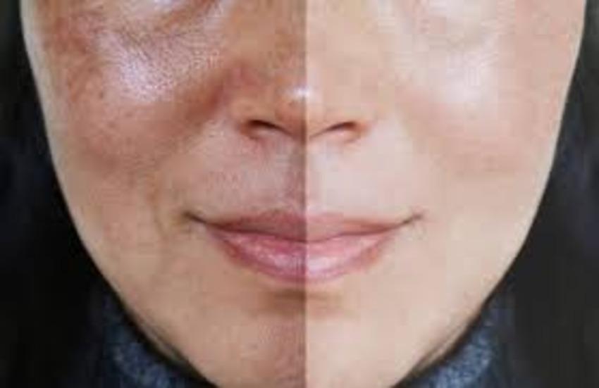 basic hydrafacials