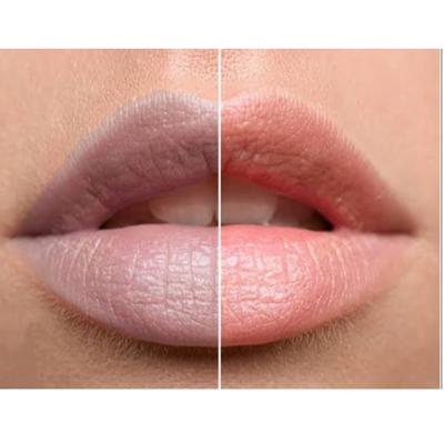 Laser treatment for hyperpigme