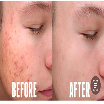 Acne peel treatments involve t