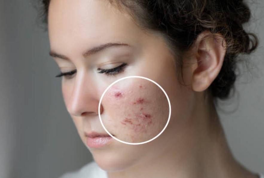 clearer skin