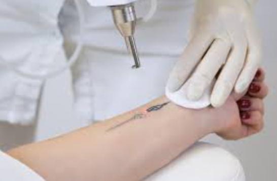 advanced laser tattoo removal 