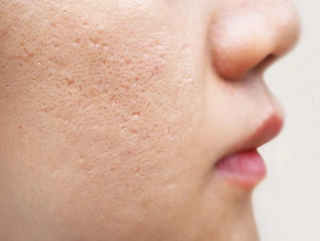 clearer skin