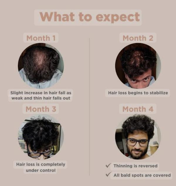 Now days hair fall and hair loss is very