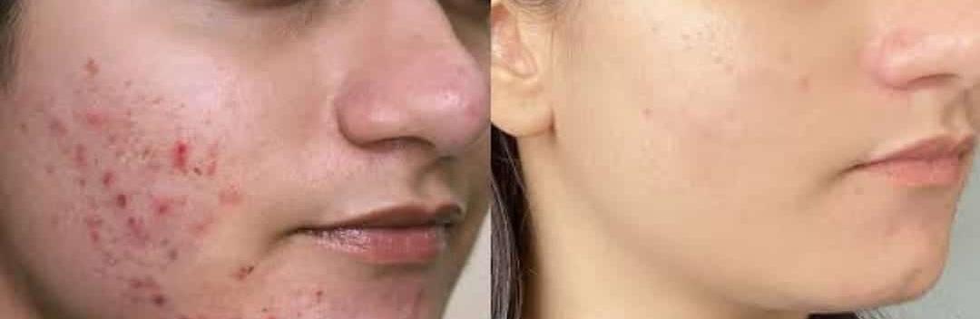 Best acne treatment in Anagha Aesthetics