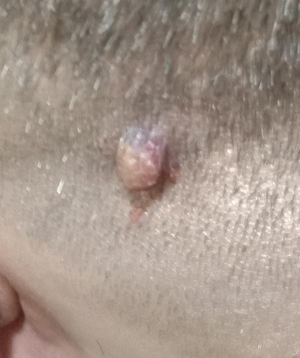 Best Successful Mole Removal treatment i