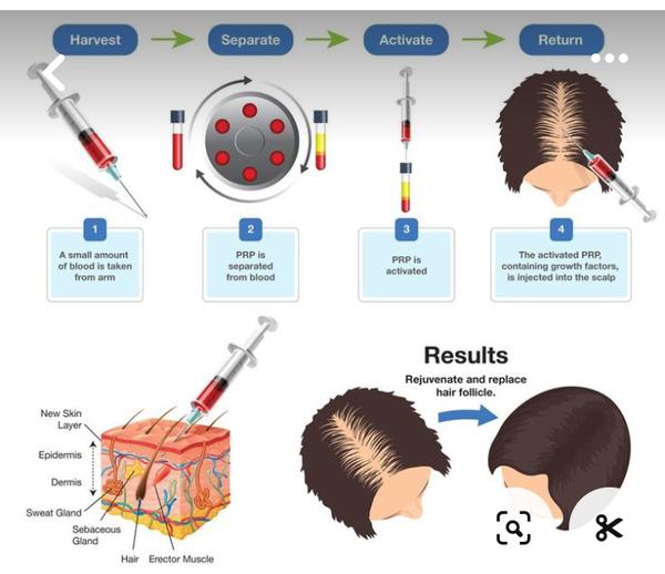 Best PRP treatment in Anagha Aesthetics 
