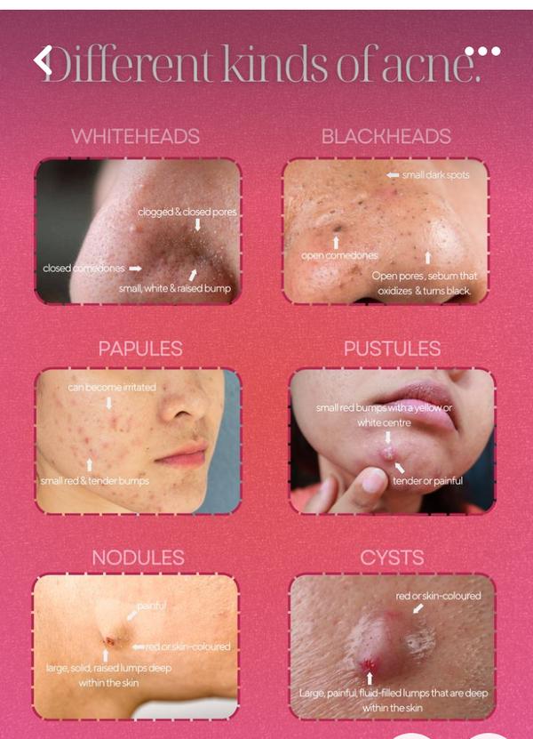 Best treatment on face Acne and skin tre