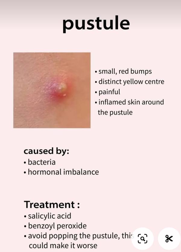 Best pustule treatment in Anagha Aesthet