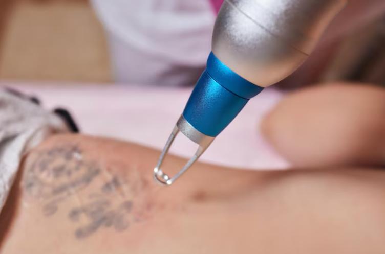 wart removal in chennai withou