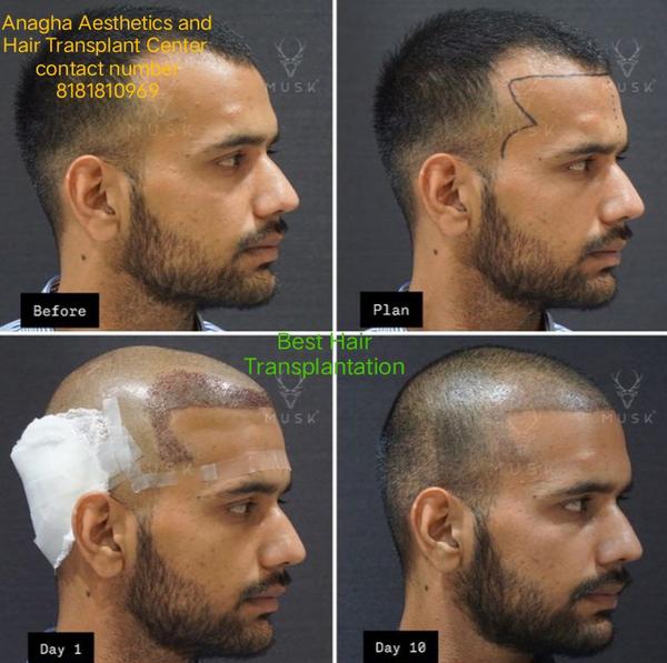 🧑‍⚕️ Anagha Aesthetics and Hair Transpl