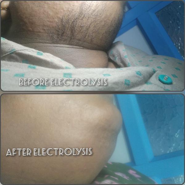 Permanent Hair Removal by ALPH