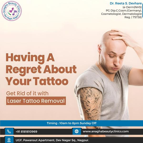 Best treatment of here Tattoo Removal La