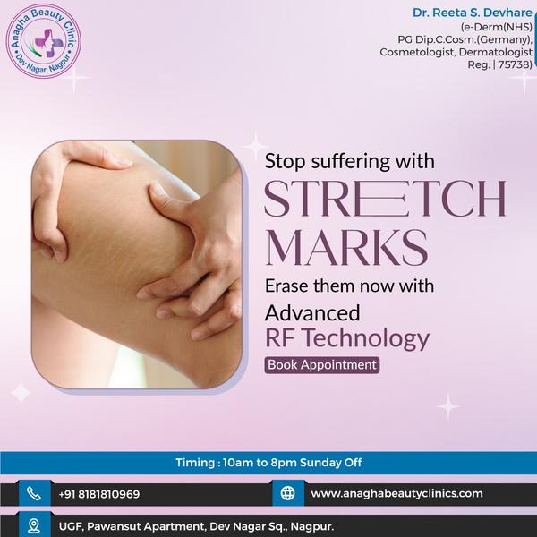 Best treatment on Strech Marks in Anagha