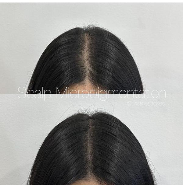 SMP is a cosmetic treatment for balding 