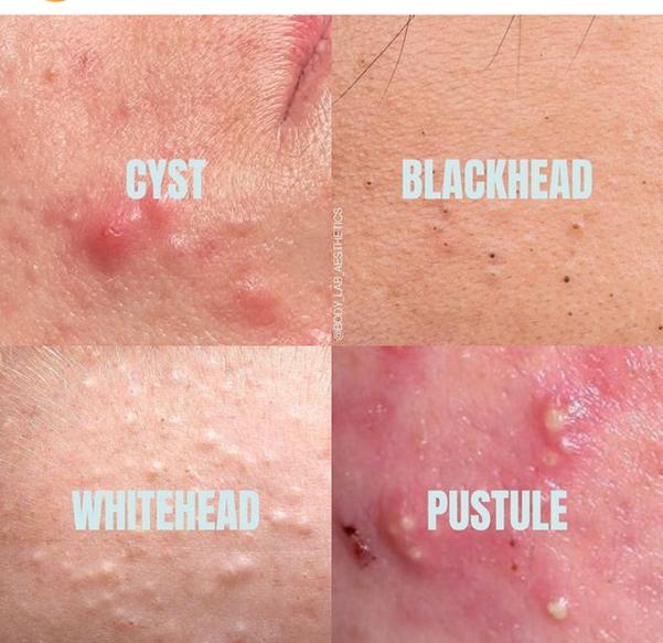 Best treatment on  your Acne, cyst, Blac