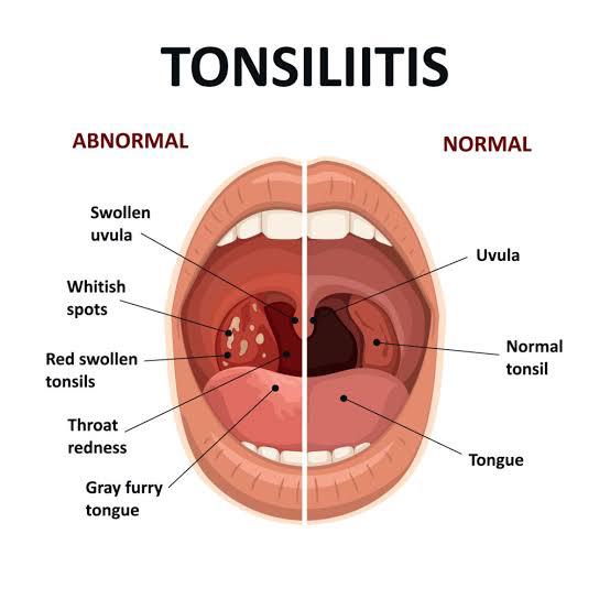 recurrent tonsillitis treatmen