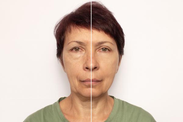 microneedling botox