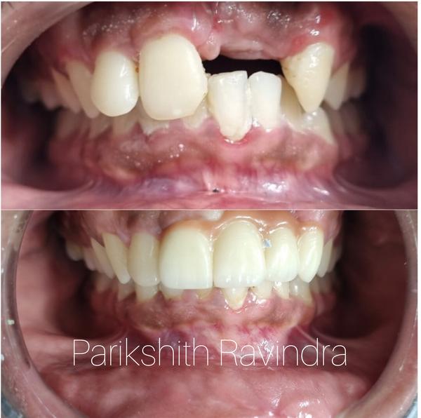 dental prosthetic