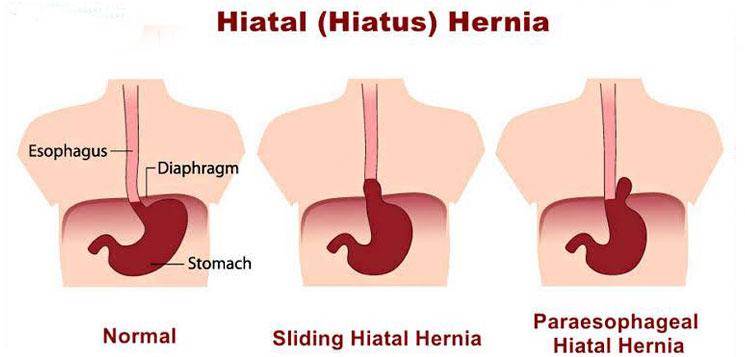 normal hiatushole