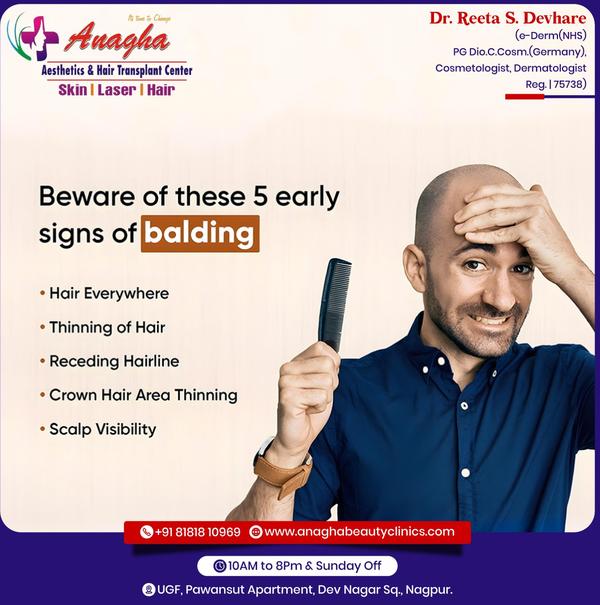 Best treatment on Balding problem in Ana
