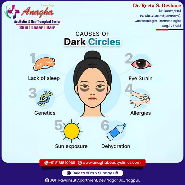 Proper Dark circle treatment in Anagha A